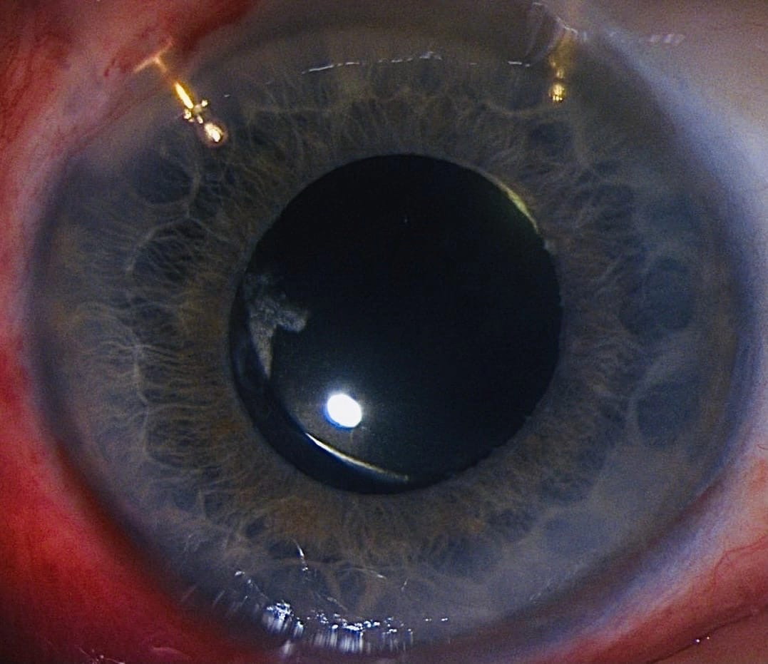 Фото левого глаза после имплантации второго МШ