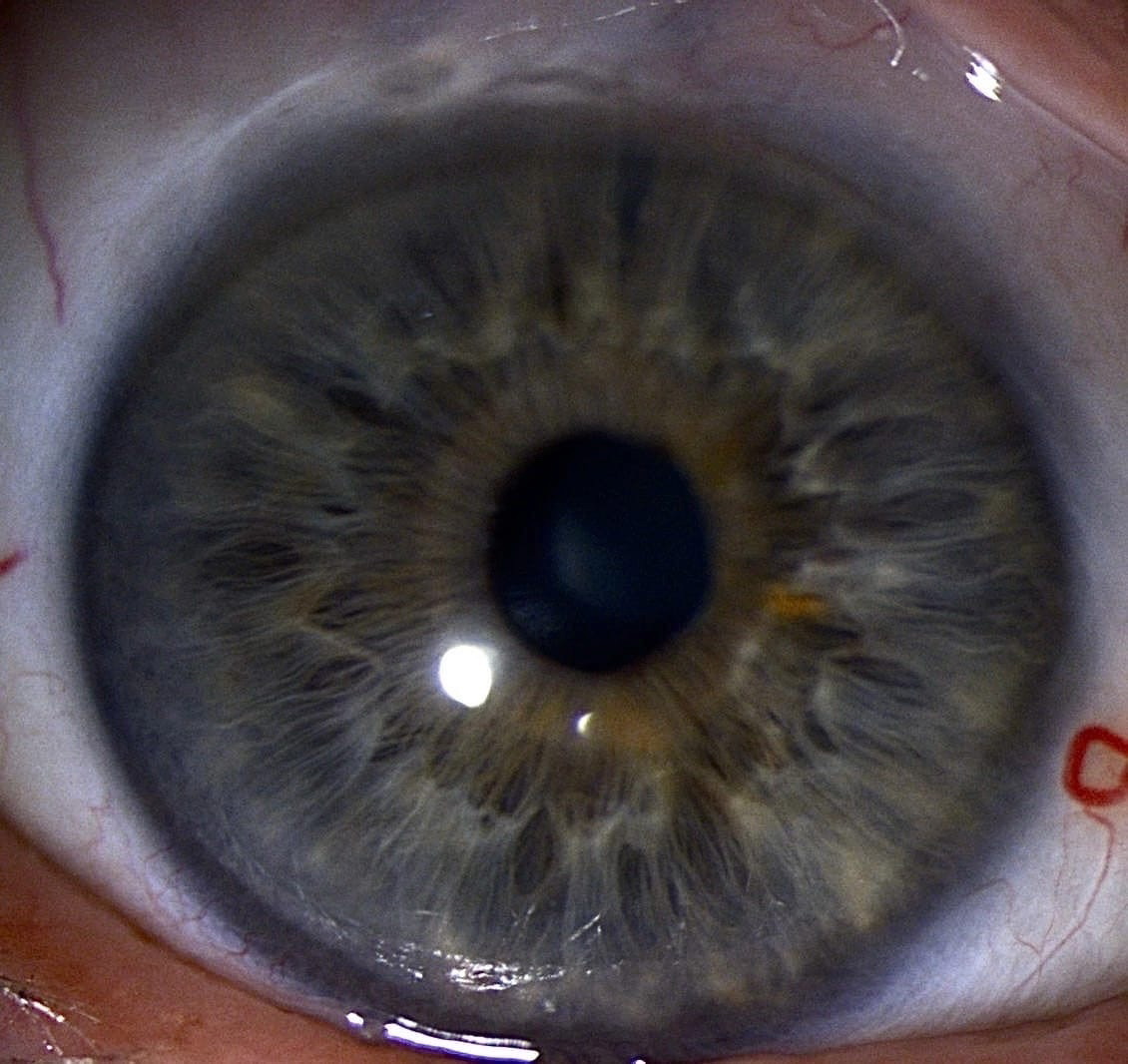 Биомикроскопия переднего отрезка правого глаза