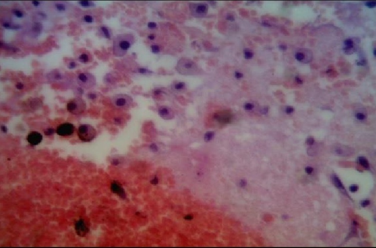 Пример микрофотография коры полушарий головного мозга через 72 часа от начала эксперимента у крыс в группе №2, х100, окр. гематоксилин + эозин