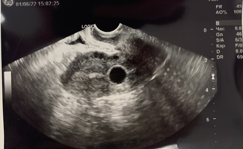 Катетер Foley в полости матки, при трансвагинальном УЗ-сканировании
