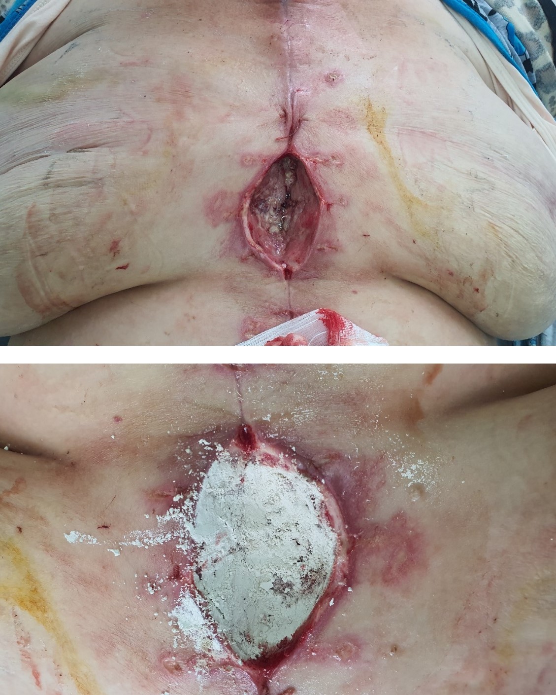 Infected chest wall wound after treatment with modified silver monmorillonite