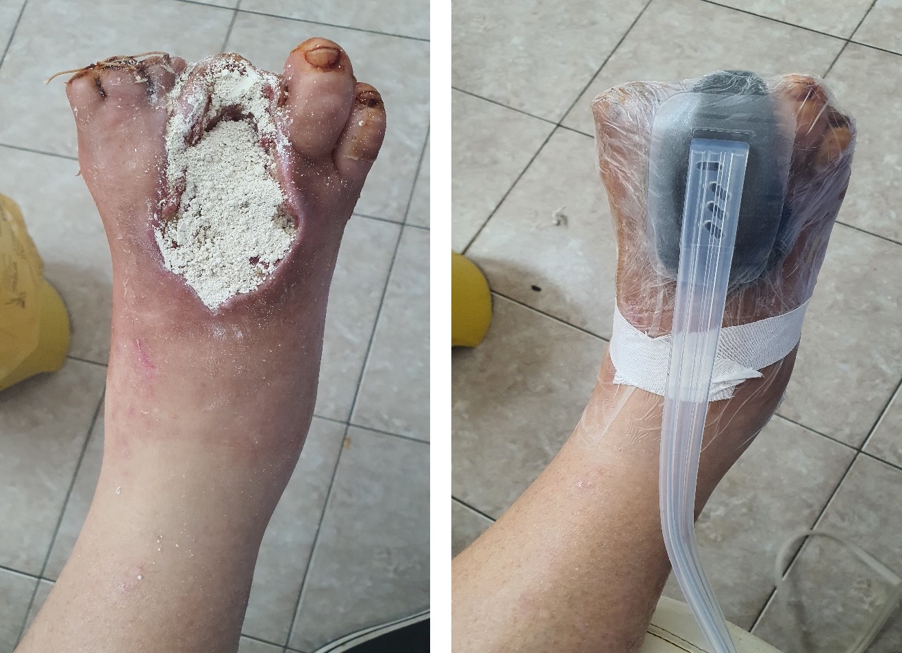 Treatment of an infected foot wound with VAC therapy