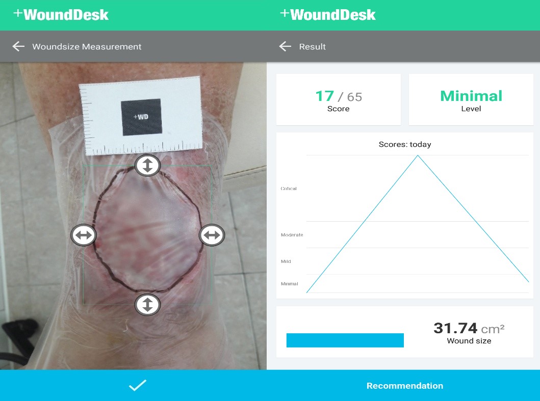 Determination of the area of the infected ulcer of the lower leg using the mobile app +WoundDesk