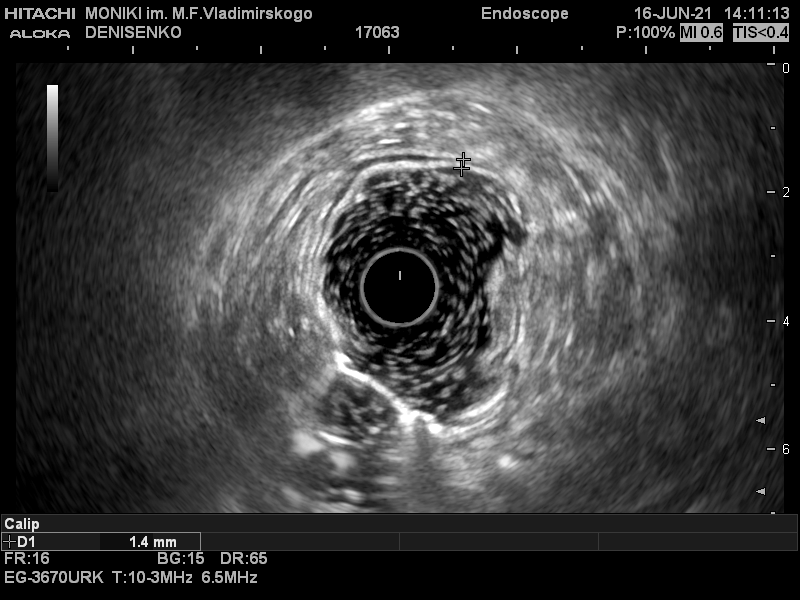 Эндосонографическое изображение стенки толстой кишки в норме