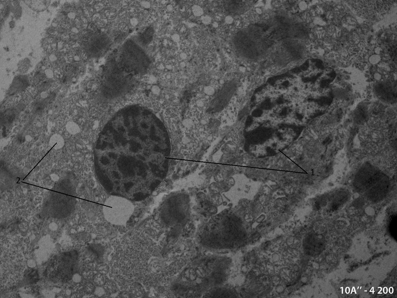 Электронномикороскопическое фото малодифференцированных кардиомиоцитов развивающегося миокарда куриного эмбриона через 24 часов после термотравмы на различных стадиях апоптотической гибели:1 - уплотнения хроматина в ядрах кардиомиоцитов; 2 - апоптотические тельца