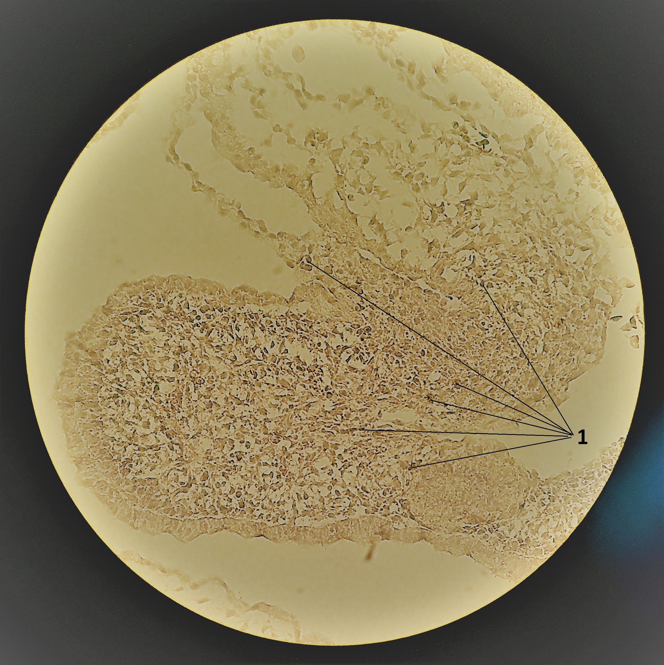 Компактный миокард куриного эмбриона:1 - малодифференцированные кардиомиоциты на различных стадиях апоптотической гибели