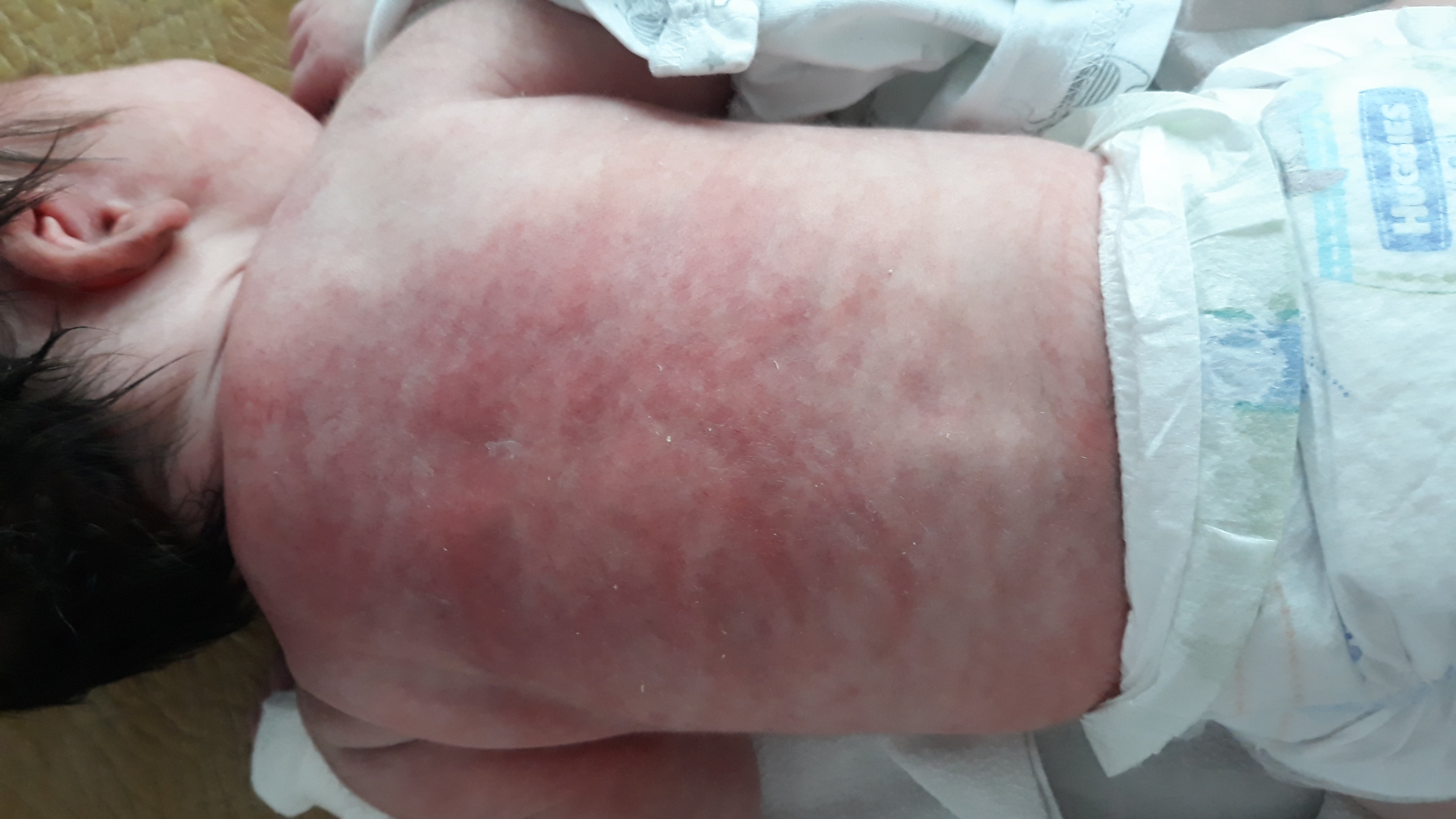 Кожные проявления адипонекроза в возрасте 3-х недель жизни