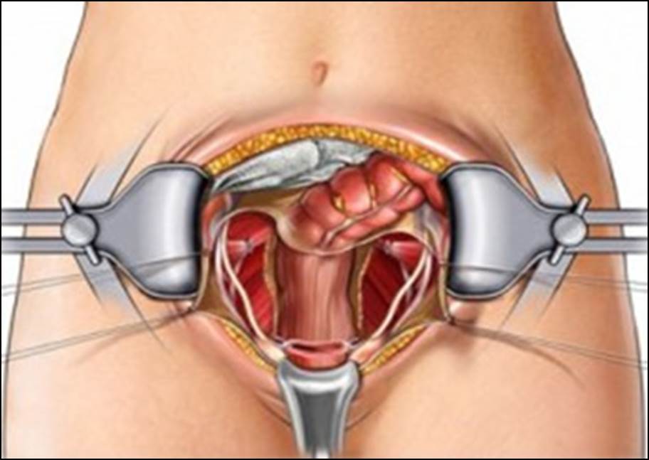 Пример изображения для интеграции в видеозапись оперативного вмешательства «Внематочная беременность»