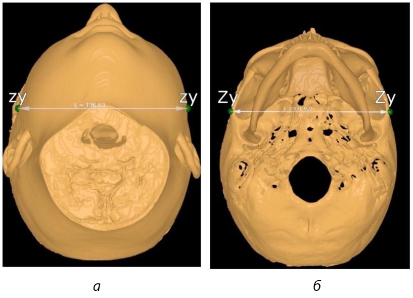 Фотография компьютерной томограммы на этапе определения широтных параметров: а – ориентиры на коже расстояние (zy- zy); б – ориентиры на костях черепа расстояние (Zy - Zy)
