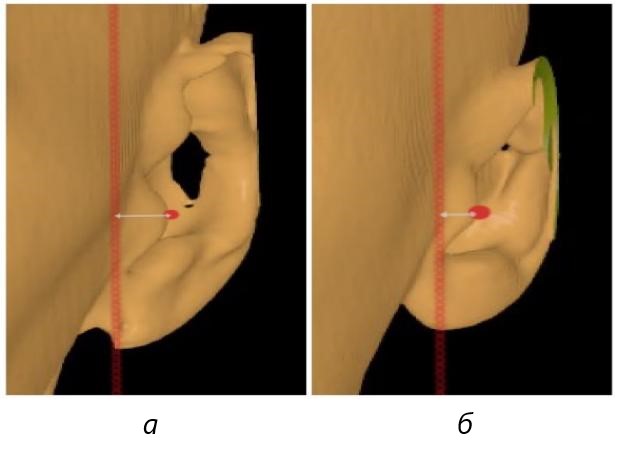 Фотография компьютерной томограммы уха: а – выраженный - высокий козелок уха; б – невыраженный - низкий козелок уха