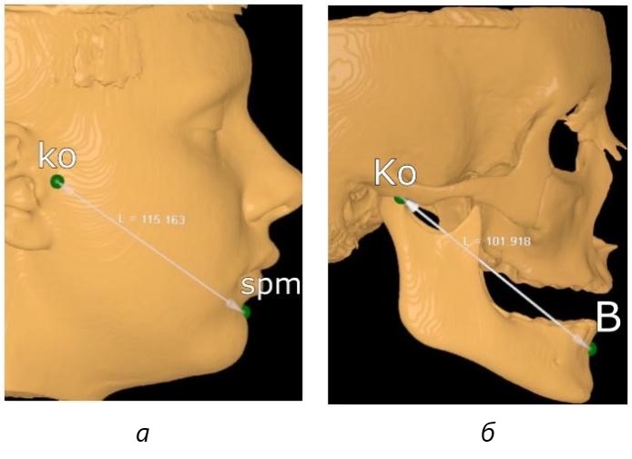 Фотография компьютерной томограммы на этапе определения широтных параметров: а – ориентиры на коже расстояние (ko - spm); б – ориентиры на костях черепа расстояние (Ko -В)