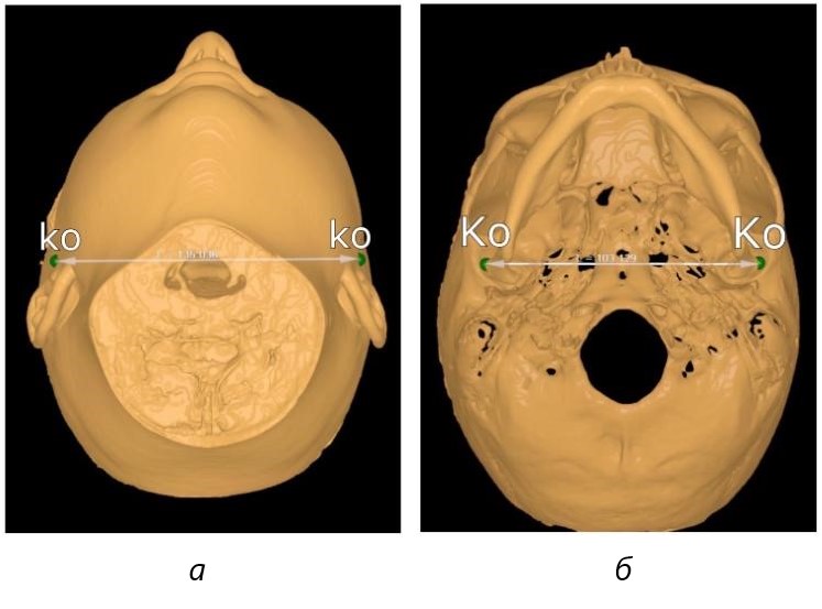 Фотография компьютерной томограммы на этапе определения широтных параметров: а – ориентиры на коже расстояние (ko-ko); б – ориентиры на костях черепа расстояние (Ko - Ko)