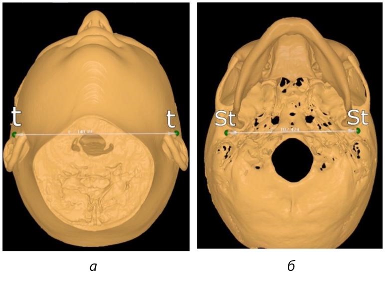 Фотография компьютерной томограммы на этапе определения широтных параметров: а – ориентиры на коже расстояние (t -t); б – ориентиры на костях черепа расстояние (St- St)