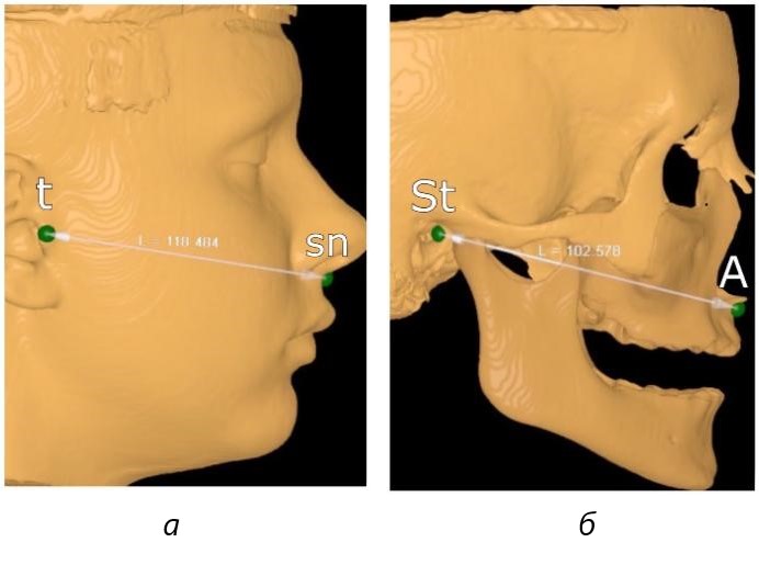 Фотография компьютерной томограммы на этапе определения широтных параметров: а – ориентиры на коже расстояние (t- sn); б – ориентиры на костях черепа расстояние (St - А)