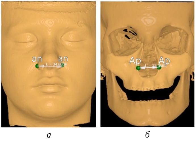 Фотография компьютерной томограммы на этапе определения широтных параметров: а – ориентиры на коже расстояние (an - an); б – ориентиры на костях черепа расстояние (Аp - Аp)