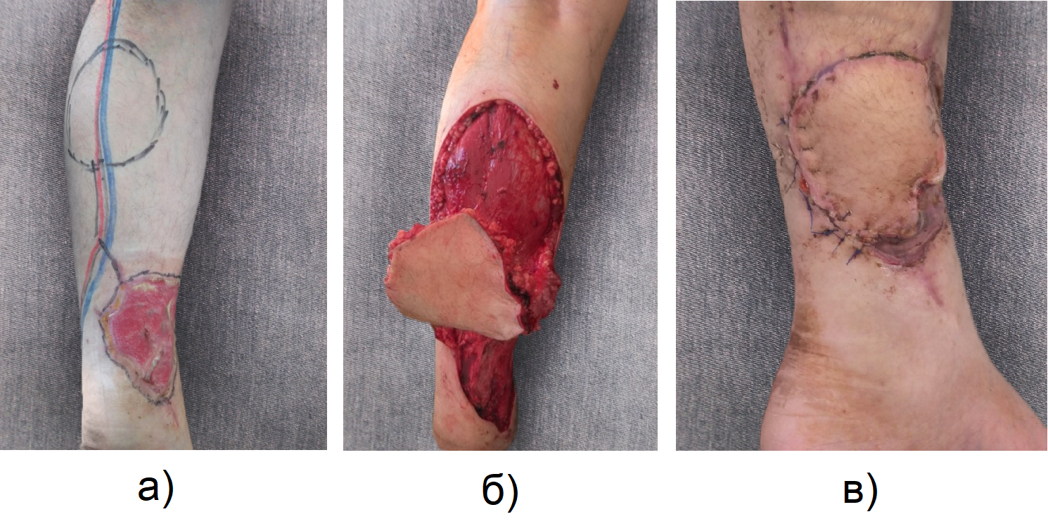 Пластика раны суральным лоскутом на дистальной ножке: а - подготовка операционного поля; б - ход операции; в - результат