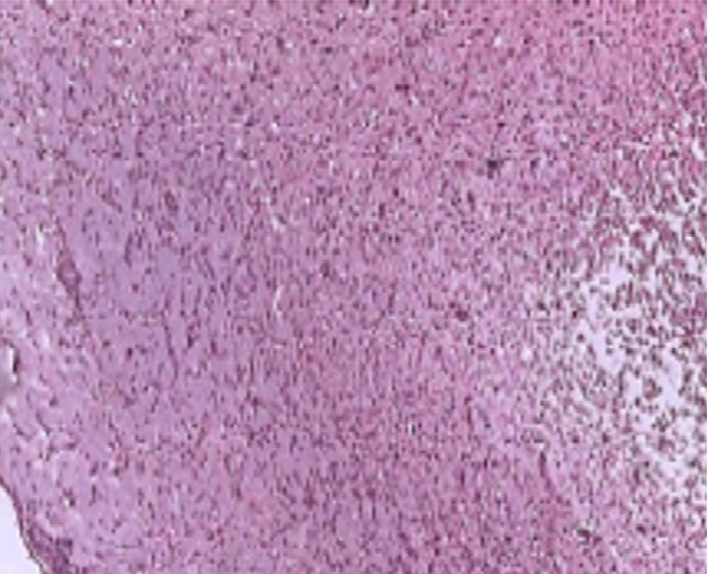 Пример деструкции вещества мозга с диффузной лейкоцитарной инфильтрацией в области инфаркта головного мозга у крыс в контрольной группе