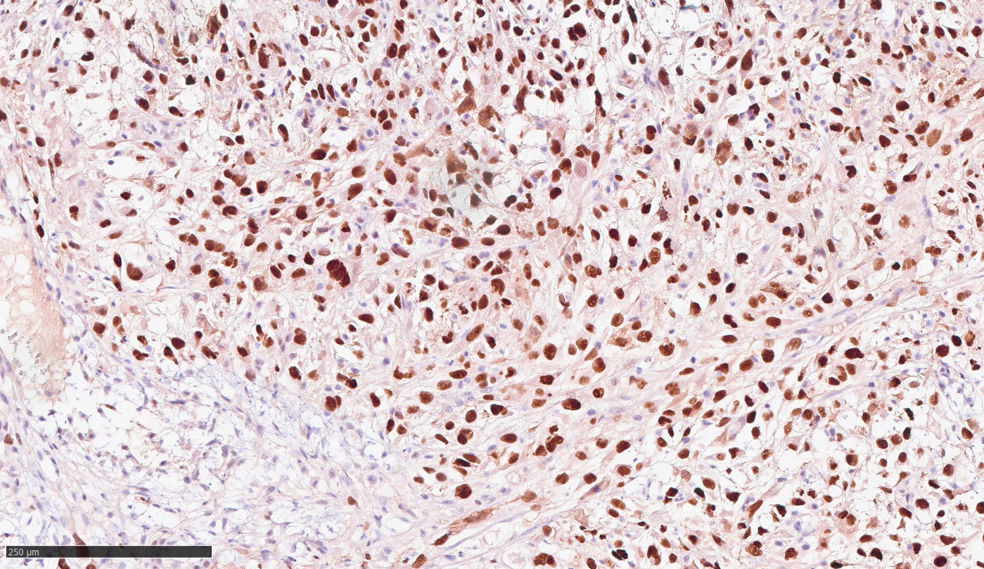 Экспрессия CD99 в опухолевых клетках (диффузная ядерная и цитоплазматическая)