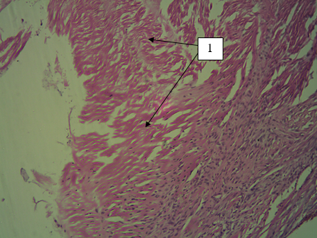  Микропрепарат фрагмента тонкого отдела кишки кошки очаг некроза новообразования, стрелка 1. Окраска гематоксилином и эозином