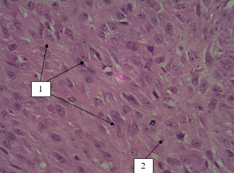  Микропрепарат фрагмента тонкого отдела кишки кошки. Опухолевые клетки веретеновидной или неправильной формы с крупными овальными ядрами с грубой структурой хроматина и 1-3 небольшими нуклеолами, стрелка 1; Митоз неопластической клетки, стрелка 2. Окраска гематоксилином и эозином