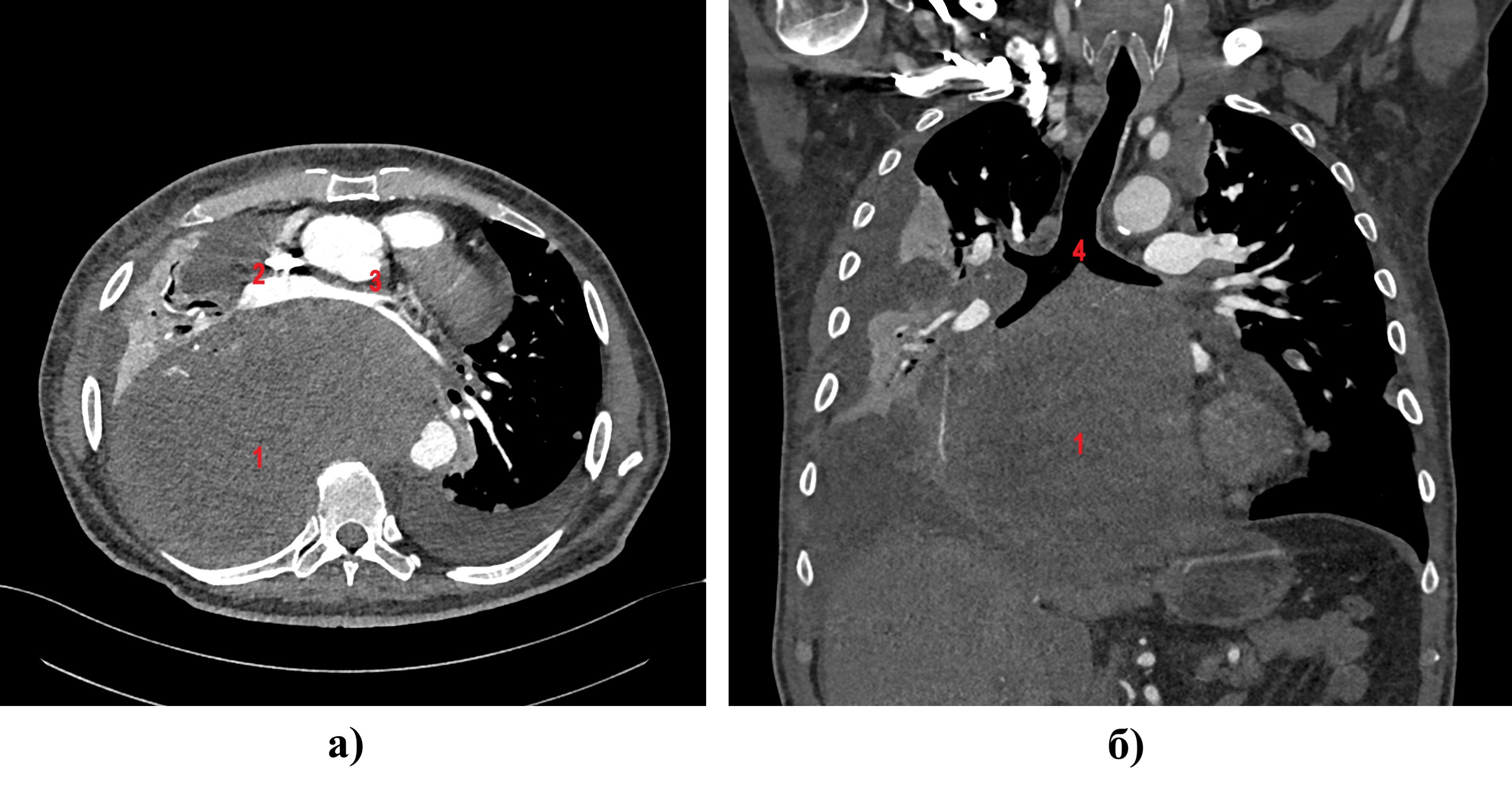 Компьютерная томография органов грудной клетки, аксиальный (а) и коронарный (б) срезы