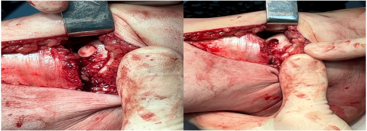 Подготовленное ложе для трансплантата (слева) и уложенный трансплантат (справа)