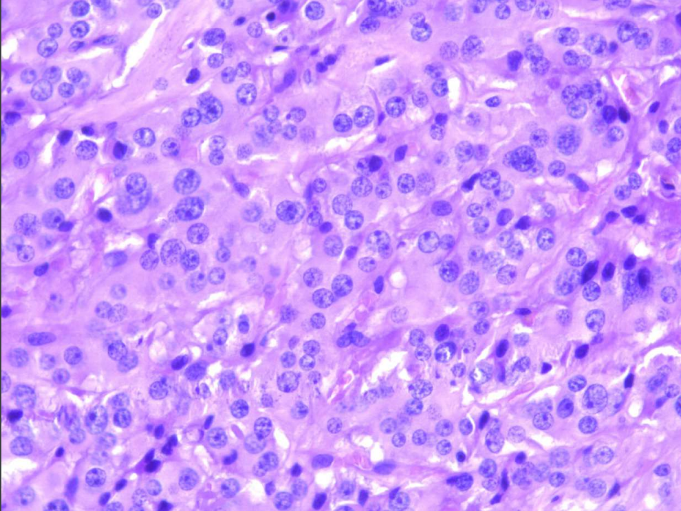 B-клеточный рак, выражен клеточный атипизм и гиперхромия ядер