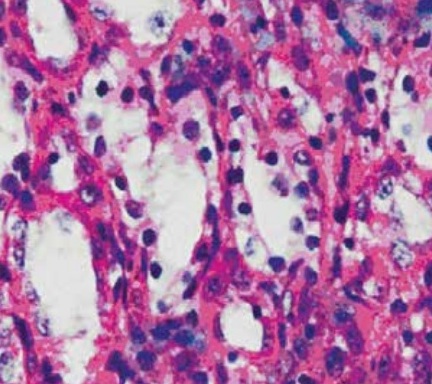 Пример гистологических изменения почечной ткани после 60-минутной ишемии и 60-минутной реперфузии, у животных в группе 2 (набухание эпителиальных клеток разрушение щеточной каемки с конденсацией ядер тубулярного эпителия)