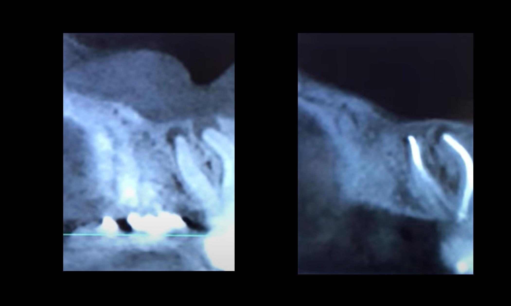 Состояние верхнечелюстной пазухи: слева - при поступлении; справа – через 10 месяцев после стоматологического лечения