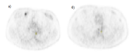 ПЭТ изображения ткани с опухолевидными новообразованиями (а), здоровой ткани (б)