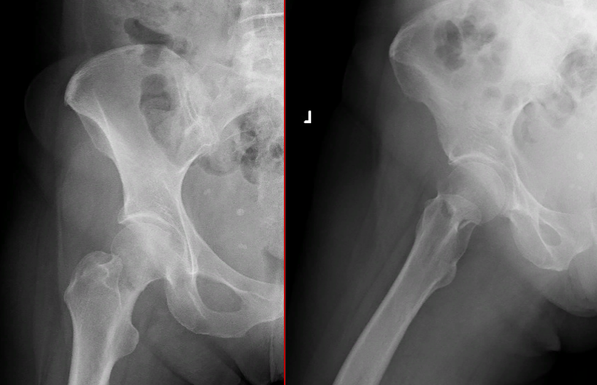 Рентгенограммы левого тазобедренного сустава в 2–х проекциях