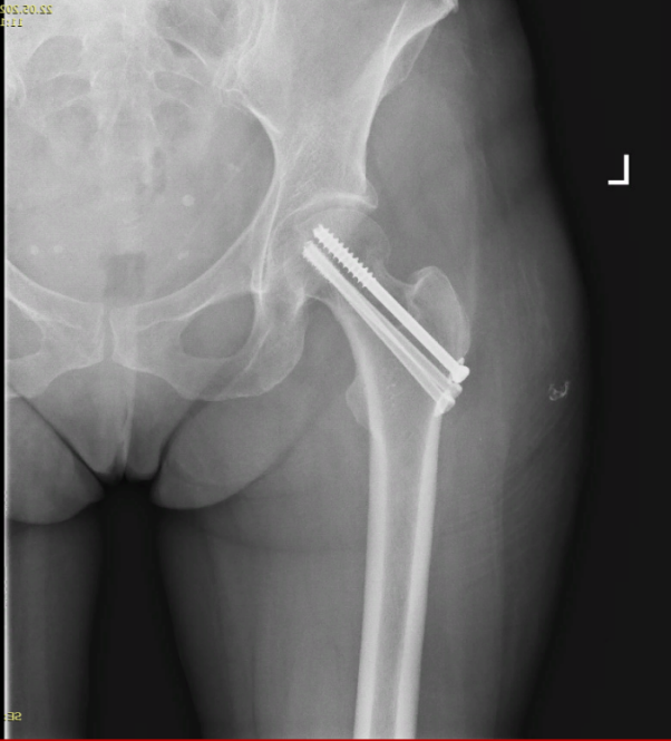 Рентген–контроль после операции остеосинтеза шейки бедренной кости 3 параллельными винтами от 05.2023 г