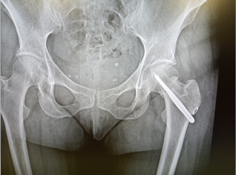 Рентген–контроль через 1,5 месяца после операции