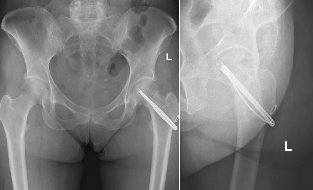Контрольные рентгенограммы после операции остеосинтеза V–образными спицами