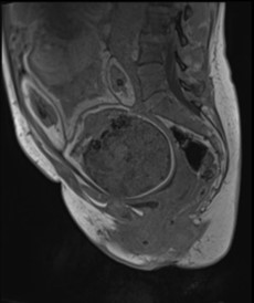  МР-томограмма таза беременной в сагиттальной плоскости, T1 Dixon Vibe