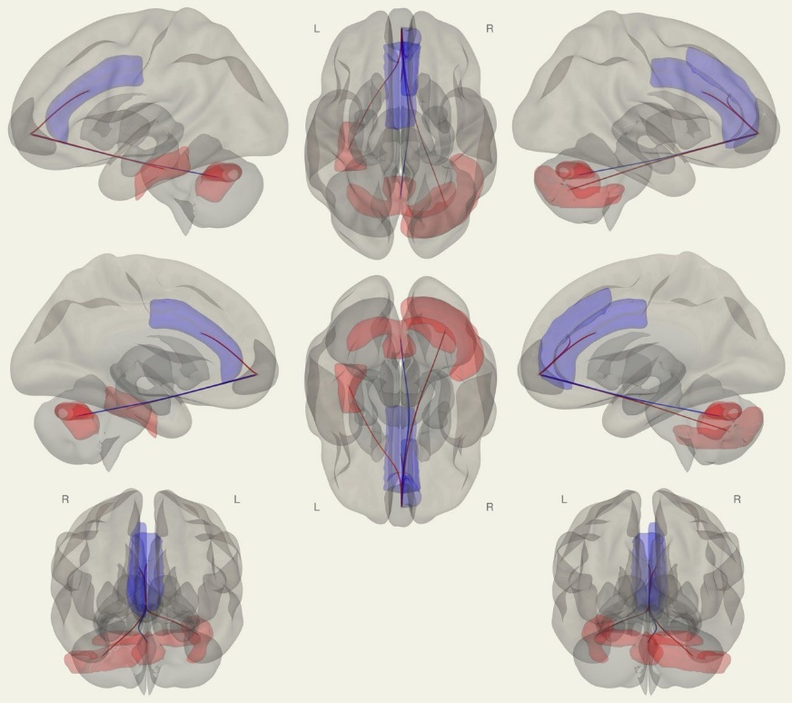 Графическое представление изменения функциональных связей головного мозга при сравнении пациентов с гиперсомнией и ишемическим инсультом и пациентами с ишемическим инсультом без нарушений сна с выбором в качестве зоны интереса медиальной префронтальной коры
