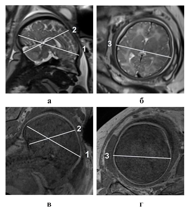  МР-томограммы головки плода в сагиттальной (а, в) и аксиальной (б, г) плоскостях