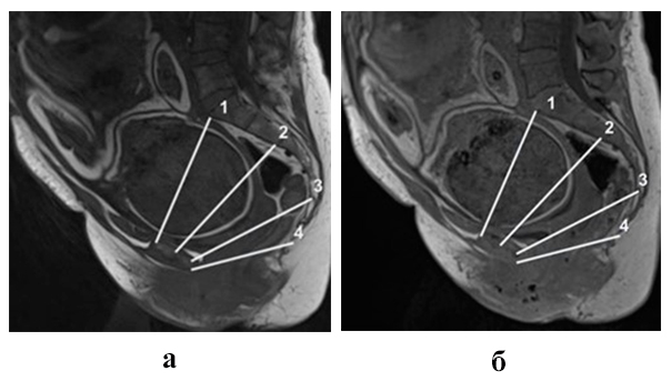  МР-томограммы полости малого таза беременной в сагиттальной плоскости, Т1-ВИ, TSE (а) и T1 Dixon Vibe (б)