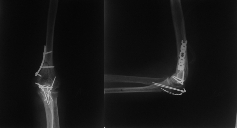 Контрольные рентгенограммы после выполнения остеосинтеза дистального метаэпифиза левой плечевой кости пластиной