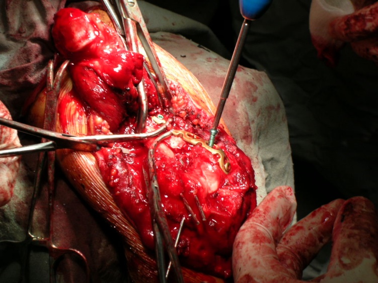 Пациент Ф. 32 года, выполнение трансолекранонового доступа к дистальному отделу плечевой кости