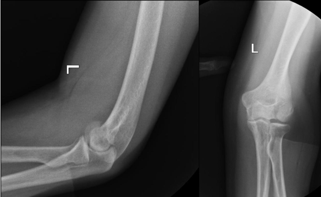 Рентгенограммы левого локтевого сустава