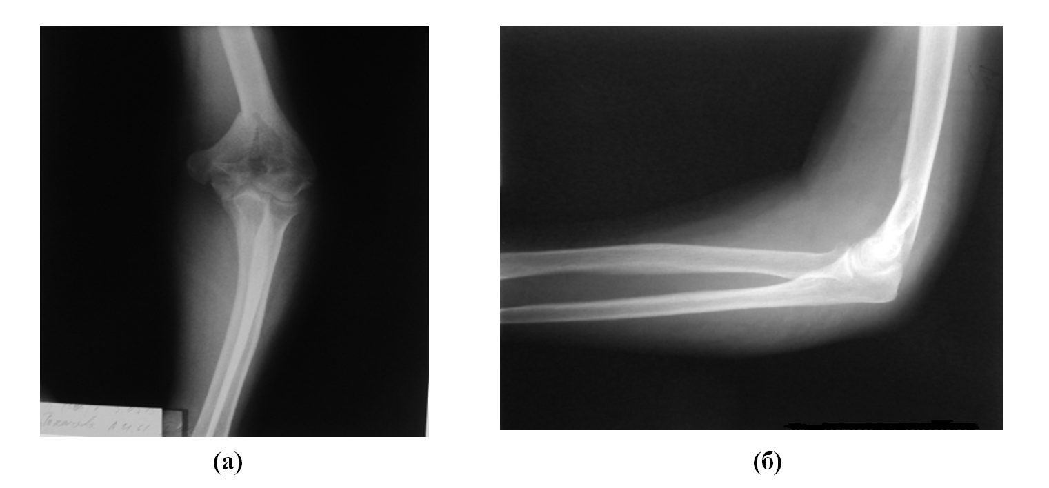 Рентгенограммы левого локтевого сустава в прямой (а) и боковой (б) проекции