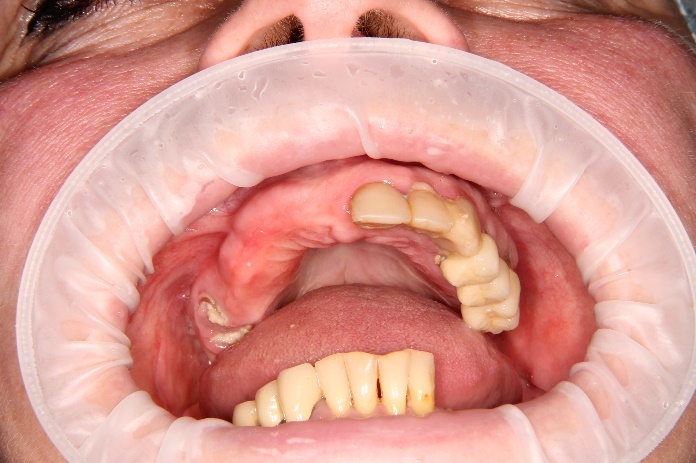 Вид в полости рта до операции