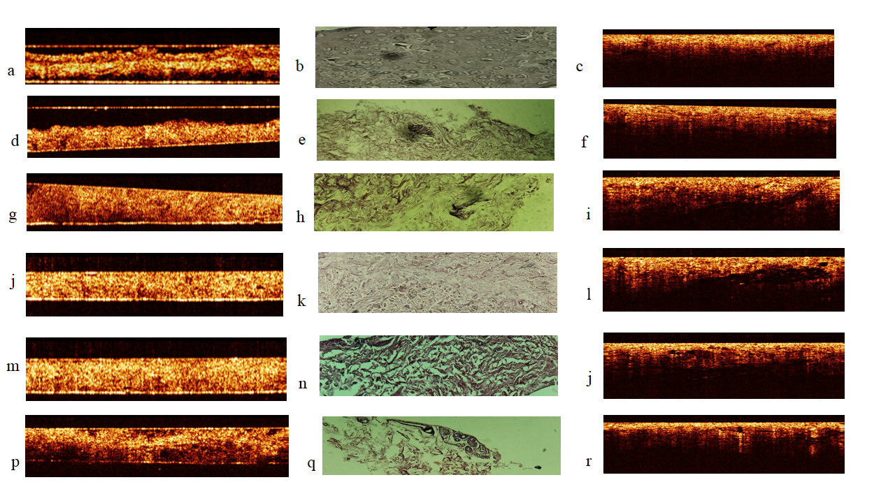 ОКТ-изображения фрагментов кожи, удаленных с помощью дерматома (a, d, g, j, m, p), соответствующих им гистологических препаратов (b, e, h, k, n, q) и участков ампутационного материала на месте последовательного удаления фрагментов дерматомом (c, f, i, l, j, r)