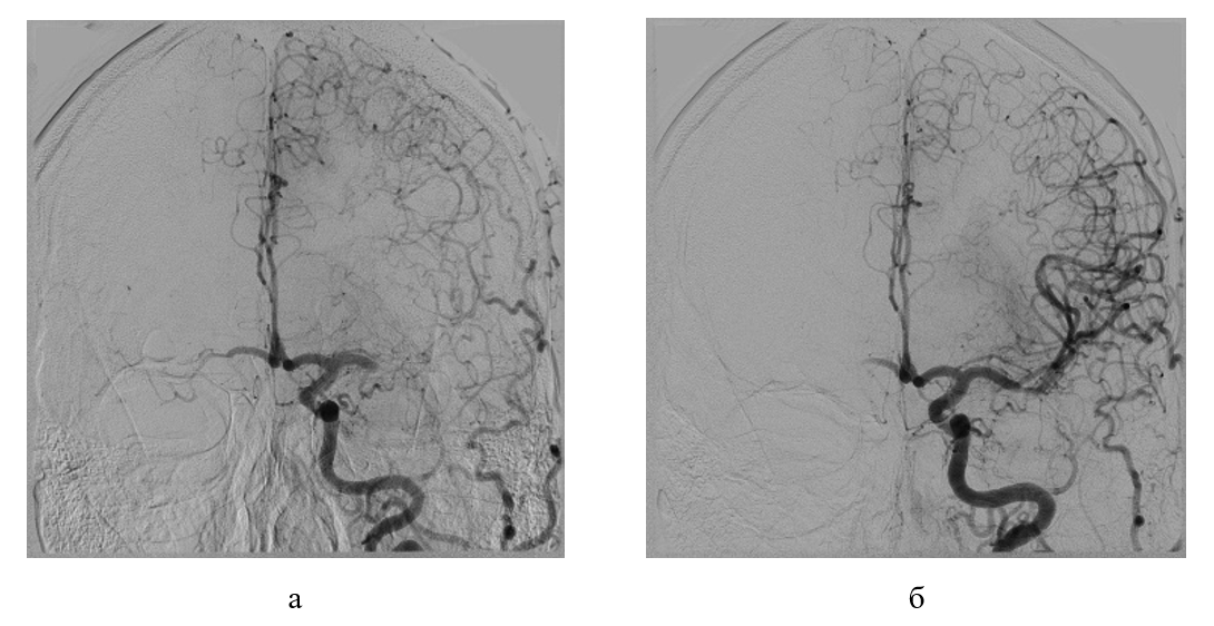 Рентгенконтрастная церебральная ангиография пациента Ц., артериальная фаза: а - окклюзия М1 сегмента левой СМА с контрастированием дистальных ветвей; б - антеградная реперфузия М1 сегмента левой СМА после выполнения тромбоаспирации