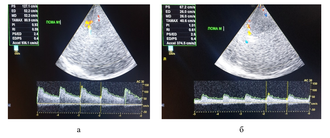 Транскраниальное дуплексное сканирование пациента Ц. при поступлении в стационар: а - систолическая (Vsist = 127,1 см/с) и усредненная по времени средняя (TAMAX = 80,9 см/с) скорости кровотока и индексы периферического сопротивления (PI = 0,9; RI = 0,6) в М1 сегменте правой СМА в пределах нормативных значений; б - гипоперфузия в М2 сегменте левой СМА в виде снижения систолической (Vsist 67,2 = см/с) и усредненной по времени средней (TAMAX 40,6 = см/с) скоростей кровотока