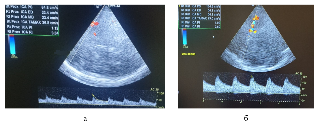 Транскраниальное дуплексное сканирование пациентки К.: а - при поступлении в стационар; б - на 3 сутки после ТЛТ 