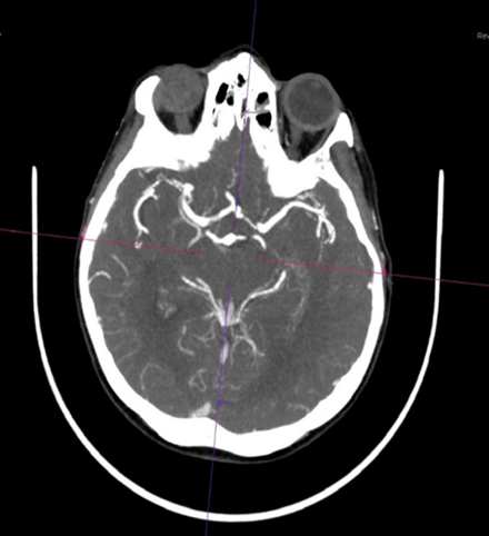 КТА артерий головного мозга в аксиальной проекции пациентки К. при поступлении