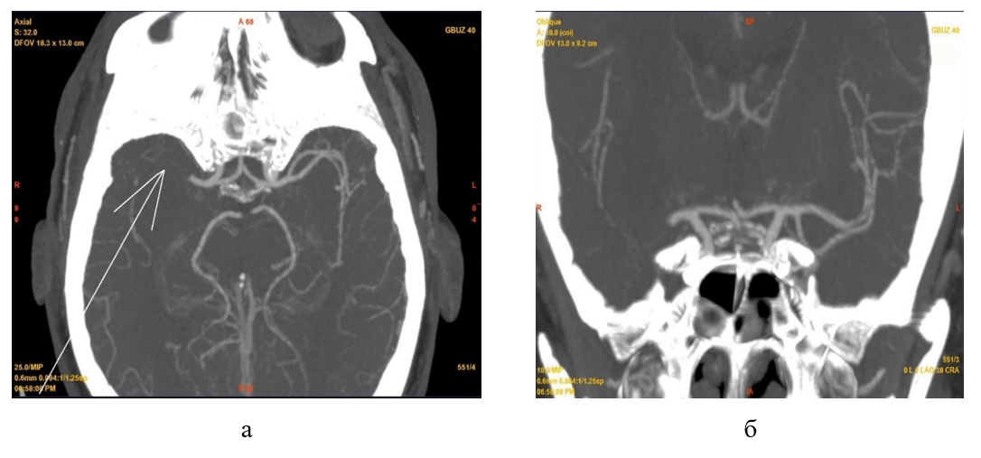 КТА артерий головного мозга пациентки Н. при поступлении: а - аксиальная проекция; б - фронтальная