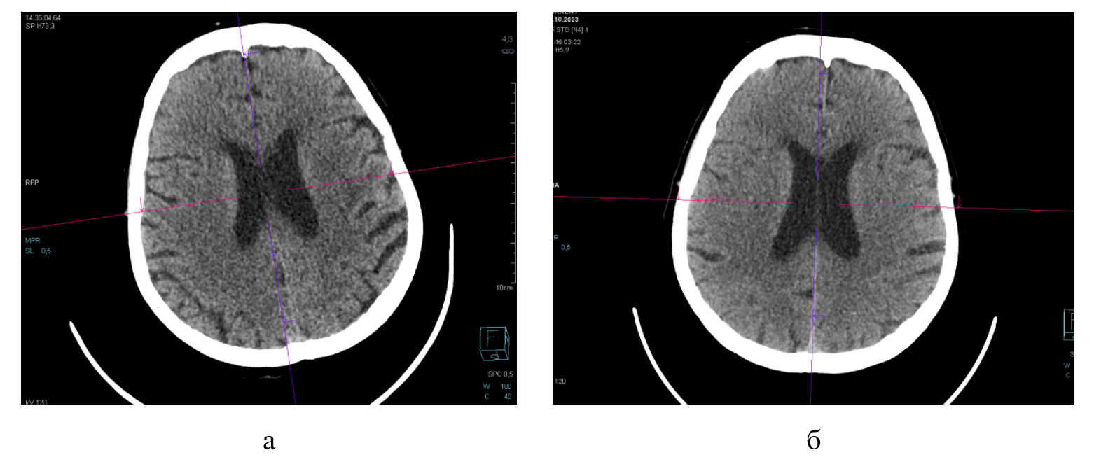 МСКТ головного мозга без контрастного усиления в аксиальной проекции пациентки К.: а - при поступлении в стационар; б - после проведения ТЛТ